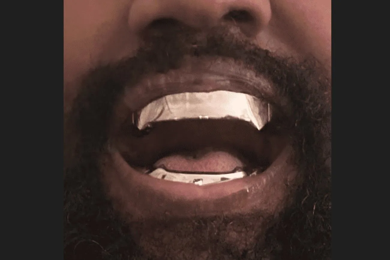 Kanye West removed his teeth! .jpg?format=webp